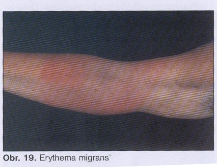 Erytéma migrans.jpg