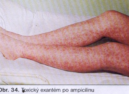 Toxoalergický exantém po ampicilínu.jpg