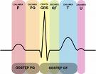 EKG krivka.jpg