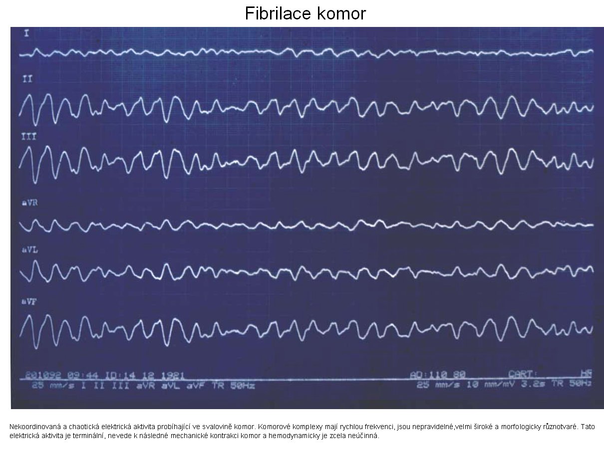 fibrilace komor.jpg