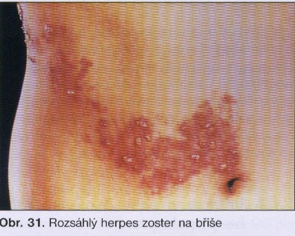 Herpes zoster na břiše.jpg