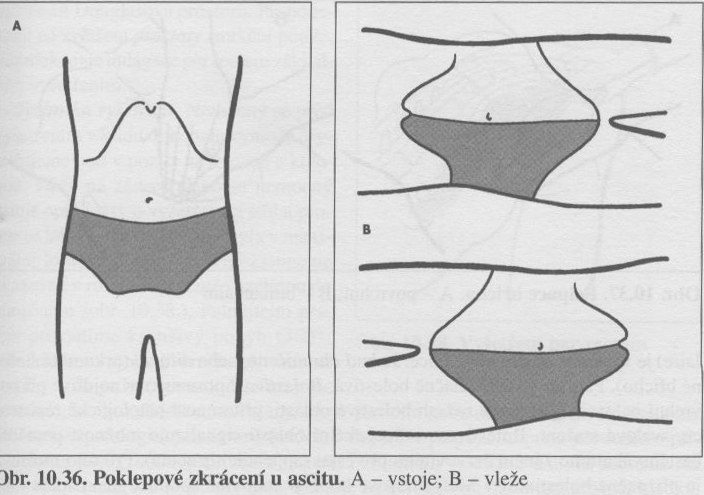 ascites - poklep.jpg