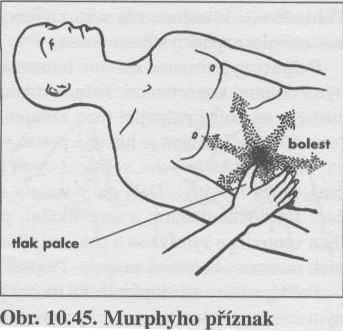 Murphyho příznak II.jpg