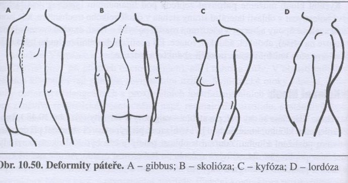 Deformity páteře.jpg